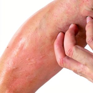 Kindle eBook Skin Ailments Multiple Sclerosis Rheumatic-0